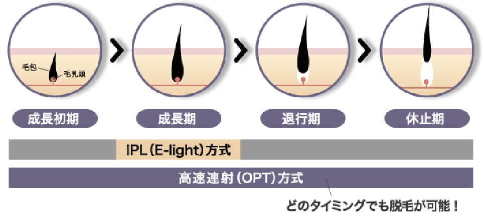 成長初期→成長期→退行期→休止期　IPL（E-light方式）、高速連射（OPT）方式（どのタイミングでも脱毛が可能！）